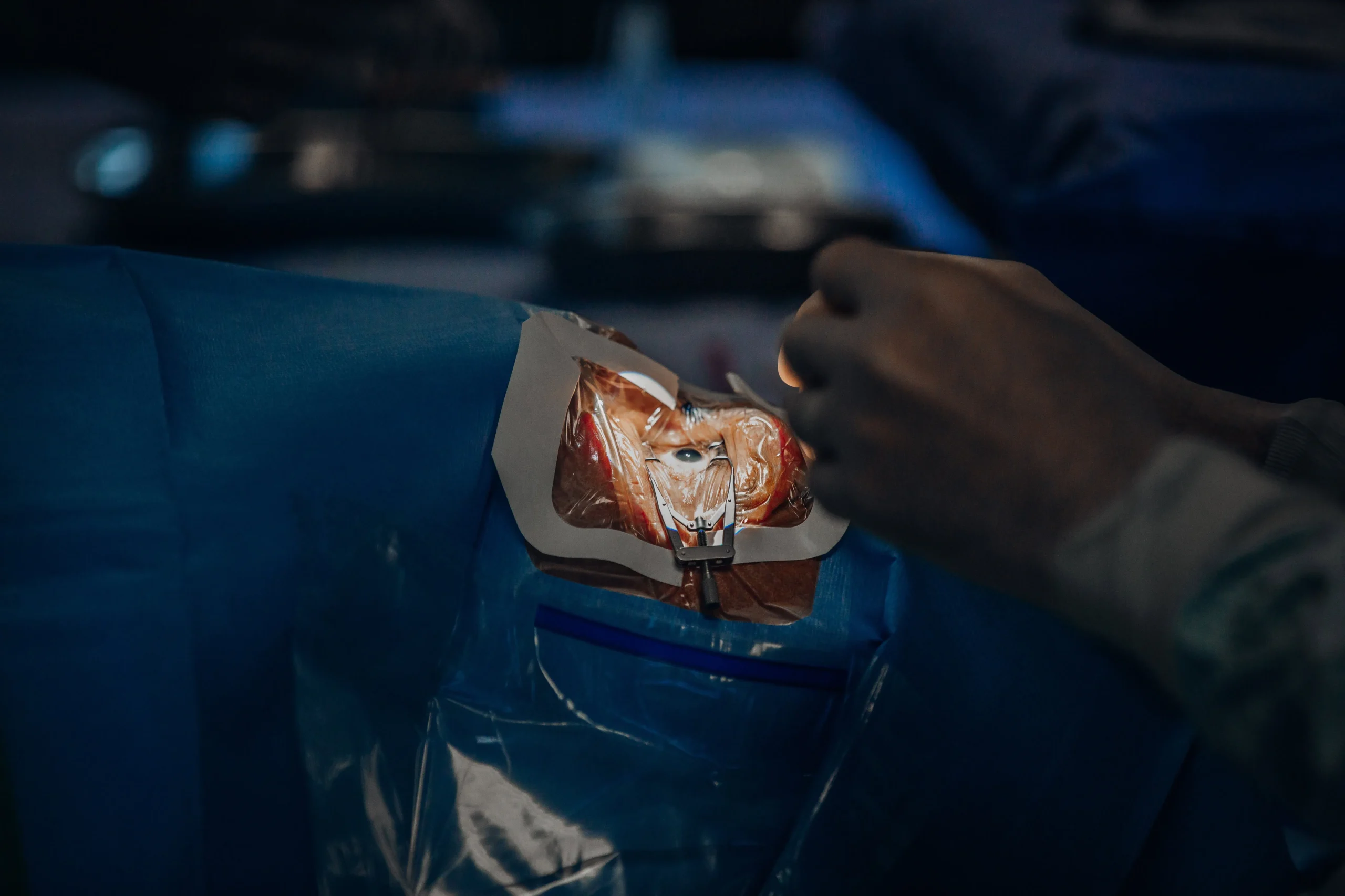 The eye prepared for surgery in theatre